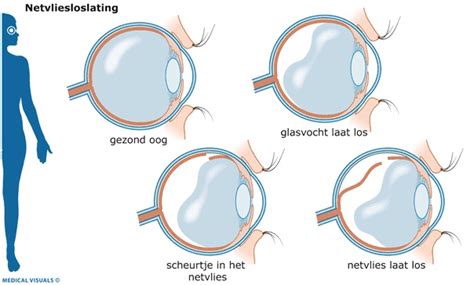 Vlekken en flitsen in het gezichtsveld .